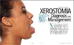 Magazine feature for Dimensions of Dental Hygiene on the subject of xerostomia